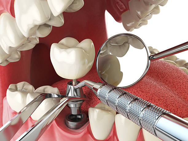 Best Emergency Tooth Extraction in Maywood, CA